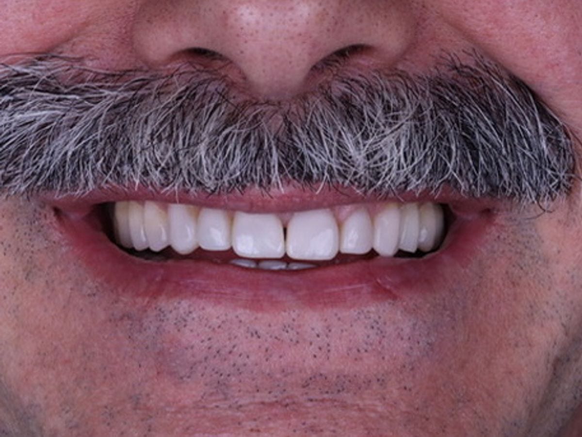 Reabilitação estética do sorriso, depois