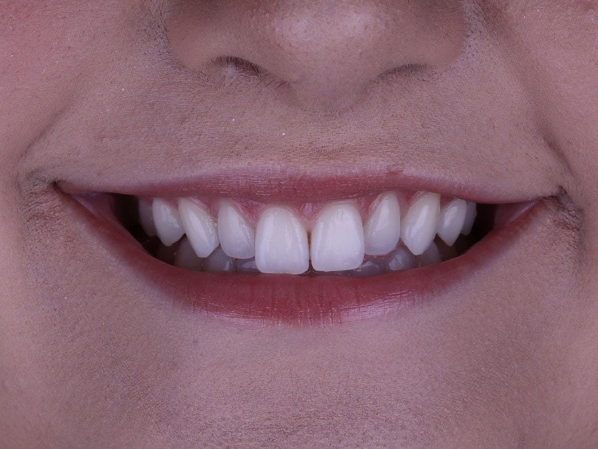 Lentes de contato dental, antes