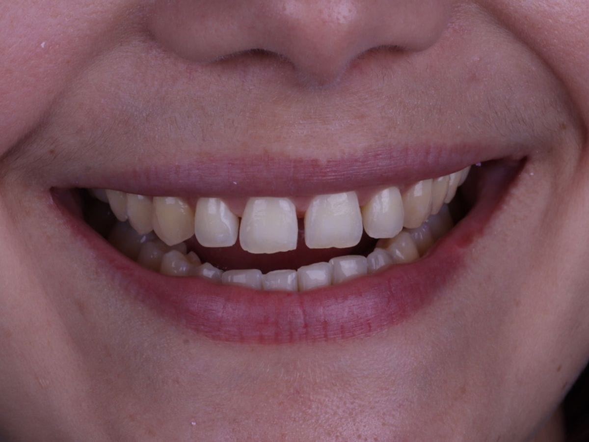 Fechamento de diastema, antes
