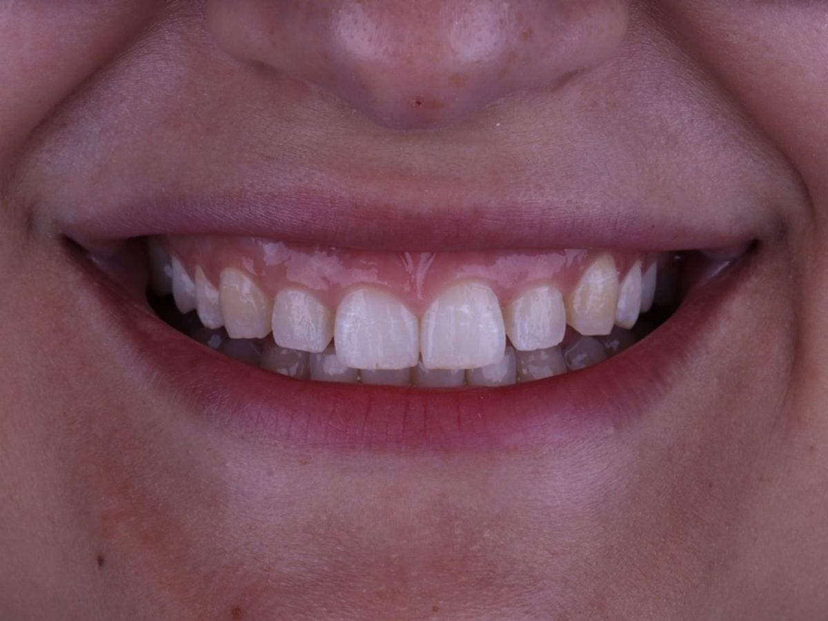 Harmonização do sorriso, antes